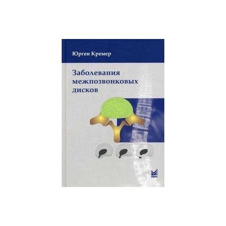 Заболевания межпозвонковых дисков